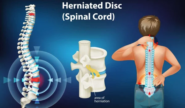 Signs of Herniated Disc
